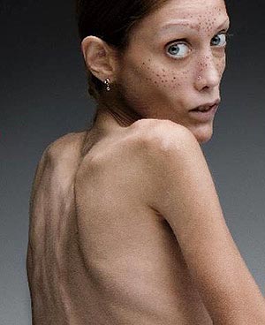 Pictures Anorexia